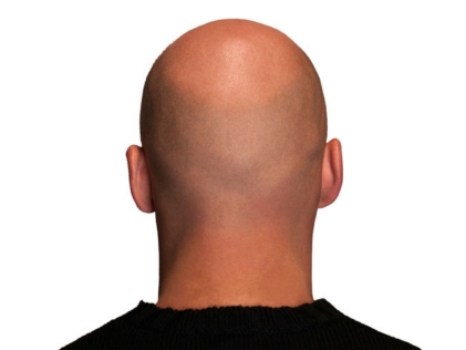 Hair Loss Bald